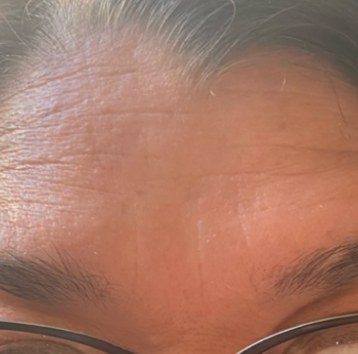 After Botox, forehead lines at Nurse Colette in Phoenix