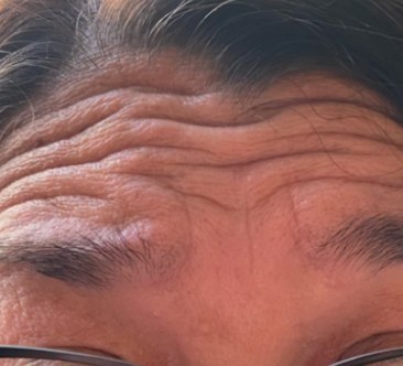 Before Botox, forehead lines at Nurse Colette in Phoenix