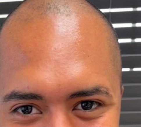 After Botox, forehead lines at Nurse Colette in Phoenix