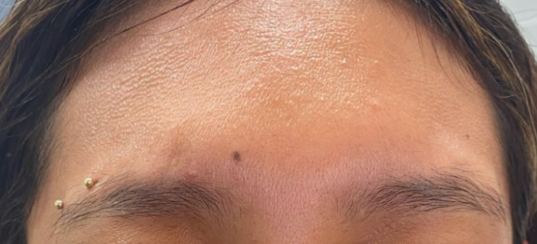 After Botox, frown lines at Nurse Colette in Phoenix