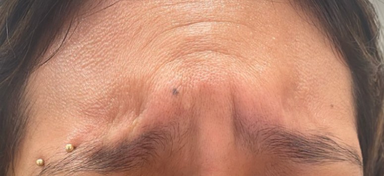Before Botox, frown lines at Nurse Colette in Phoenix