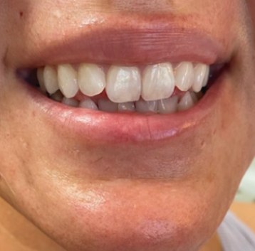 After Botox lip flip, smiling at Nurse Colette in Phoenix