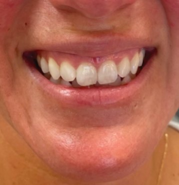 Before Botox lip flip, smiling at Nurse Colette in Phoenix
