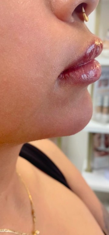 After chin filler, side profile at Nurse Colette in Phoenix
