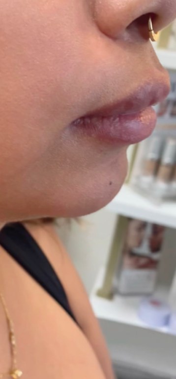 Before chin filler, side profile at Nurse Colette in Phoenix