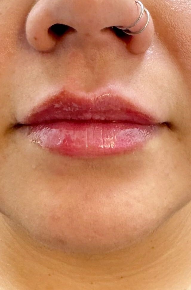 After lip filler, front view at Nurse Colette in Phoenix