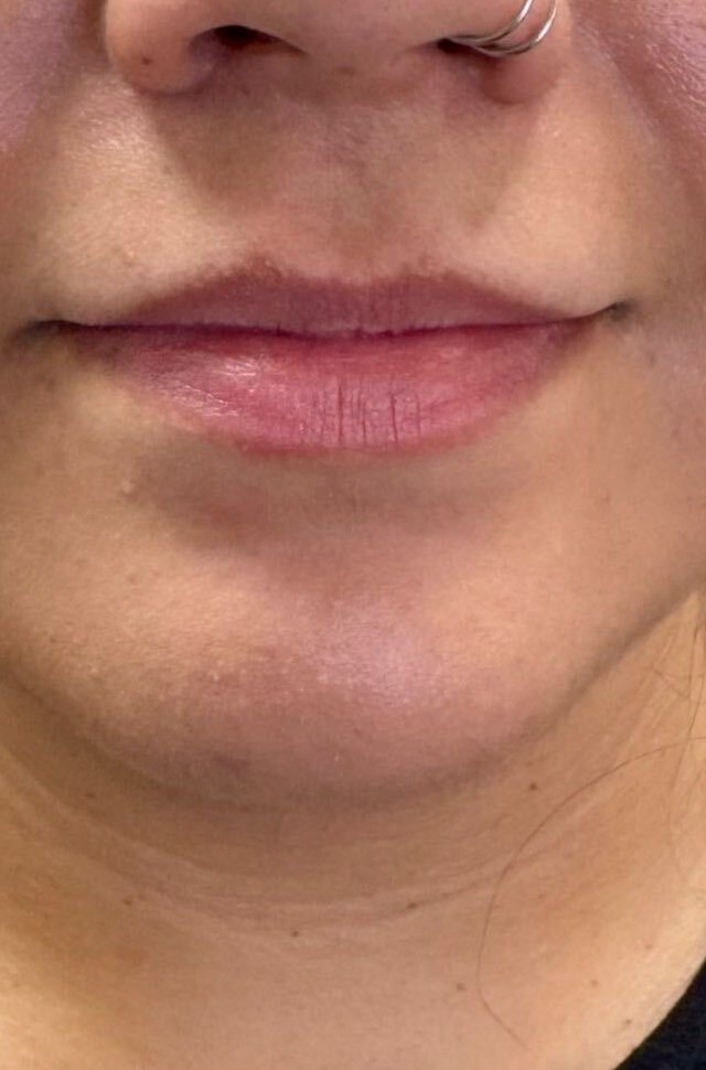 Before lip filler, front view at Nurse Colette in Phoenix