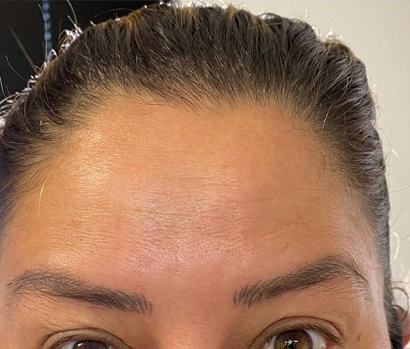 After Jeuveau, forehead lines at Nurse Colette in Phoenix