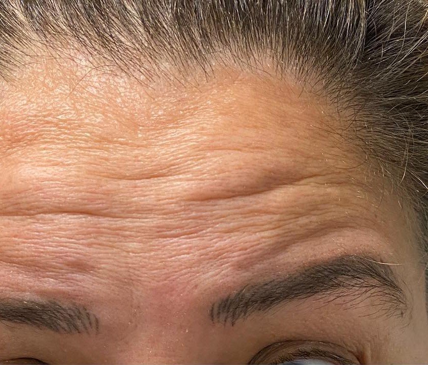 Before Jeuveau, forehead lines at Nurse Colette in Phoenix