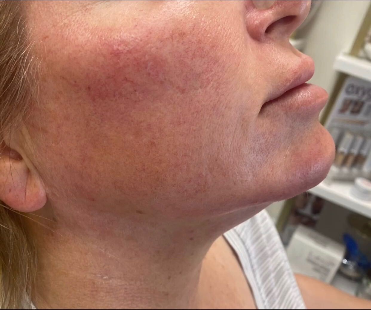 After Kybella, under the chin at Nurse Colette in Phoenix