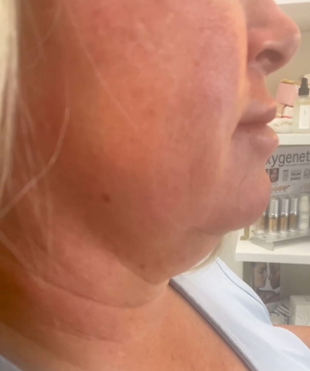 Before Kybella, under the chin at Nurse Colette in Phoenix