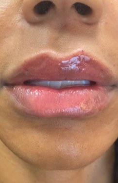 After 1 syringe of lip filler, front view at Nurse Colette in Phoenix