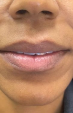 Before 1 syringe of lip filler, front view at Nurse Colette in Phoenix