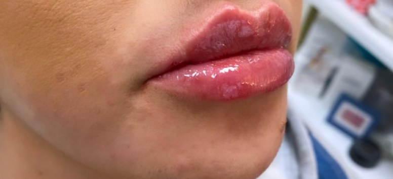 After 1 syringe of lip filler, side profile at Nurse Colette in Phoenix