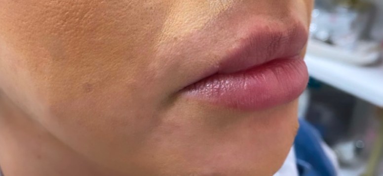 Before 1 syringe of lip filler, side profile at Nurse Colette in Phoenix