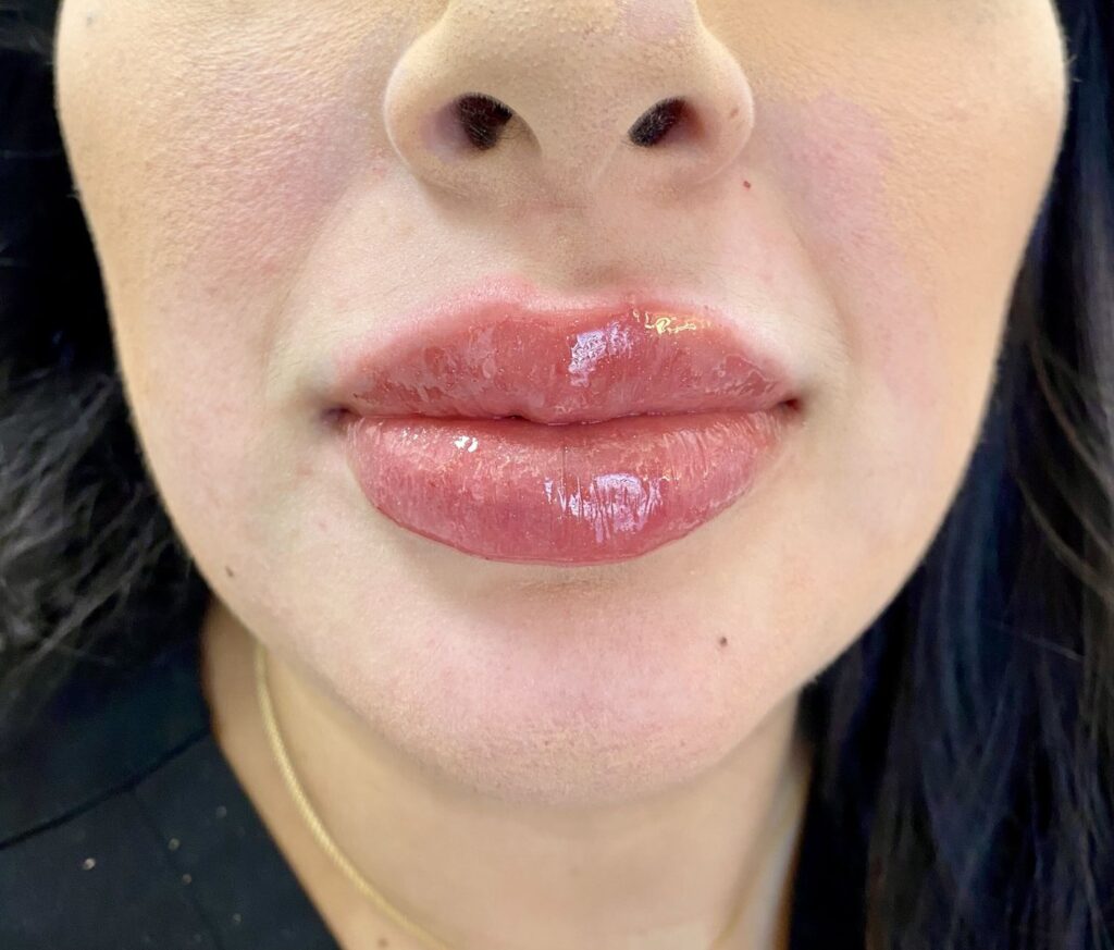 After lip filler, front view at Nurse Colette in Phoenix