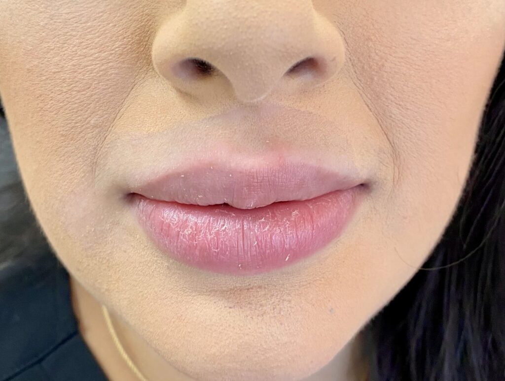 Before lip filler, front view at Nurse Colette in Phoenix