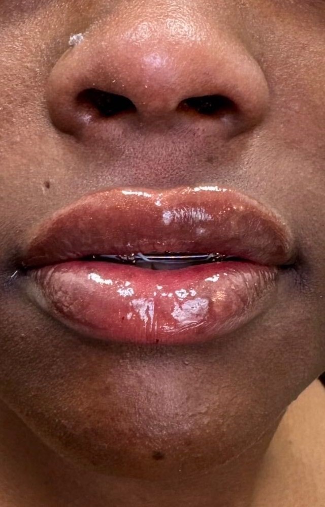 After lip filler, front view at Nurse Colette in Phoenix
