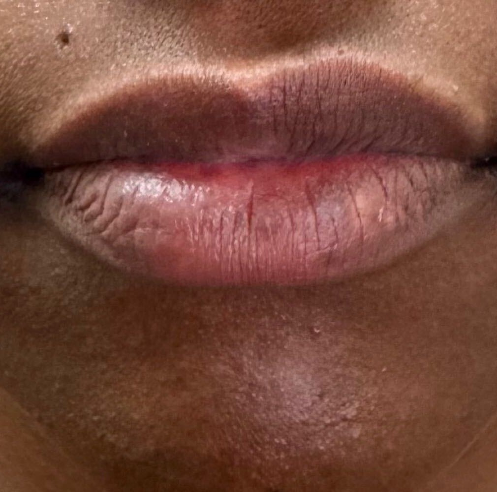Before lip filler, front view at Nurse Colette in Phoenix