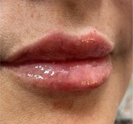After lip filler, lips profile at Nurse Colette in Phoenix