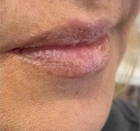 Before lip filler, lips profile at Nurse Colette in Phoenix