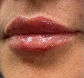 After lip filler, lips side view at Nurse Colette in Phoenix