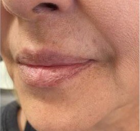 Before lip filler, lips side view at Nurse Colette in Phoenix