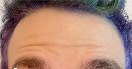 After men's tox, forehead lines at Nurse Colette in Phoenix