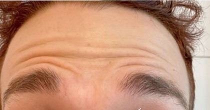 Before men's tox, forehead lines at Nurse Colette in Phoenix