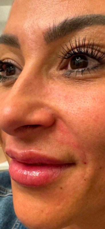 After midface filler at Nurse Colette in Phoenix
