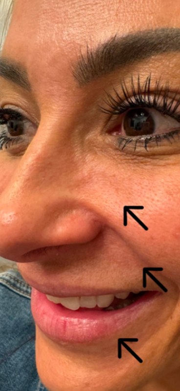 Before midface filler at Nurse Colette in Phoenix
