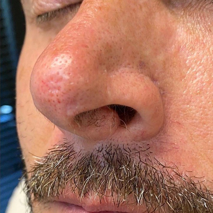 After dermal filler, nose tip at Nurse Colette in Phoenix