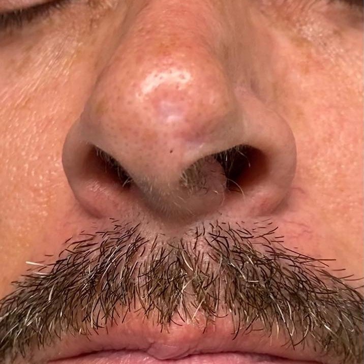 Before dermal filler, nose tip at Nurse Colette in Phoenix