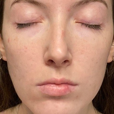 After SkinPen microneedling, face at Nurse Colette in Phoenix