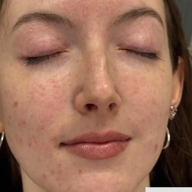 Before SkinPen microneedling, face at Nurse Colette in Phoenix