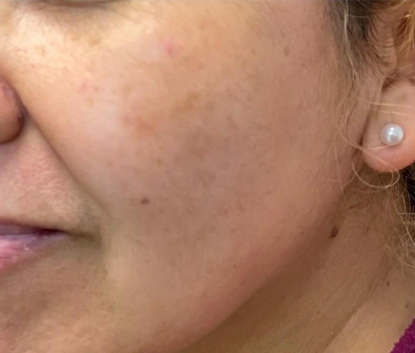 After VI Peel, hyperpigmentation at Nurse Colette in Phoenix