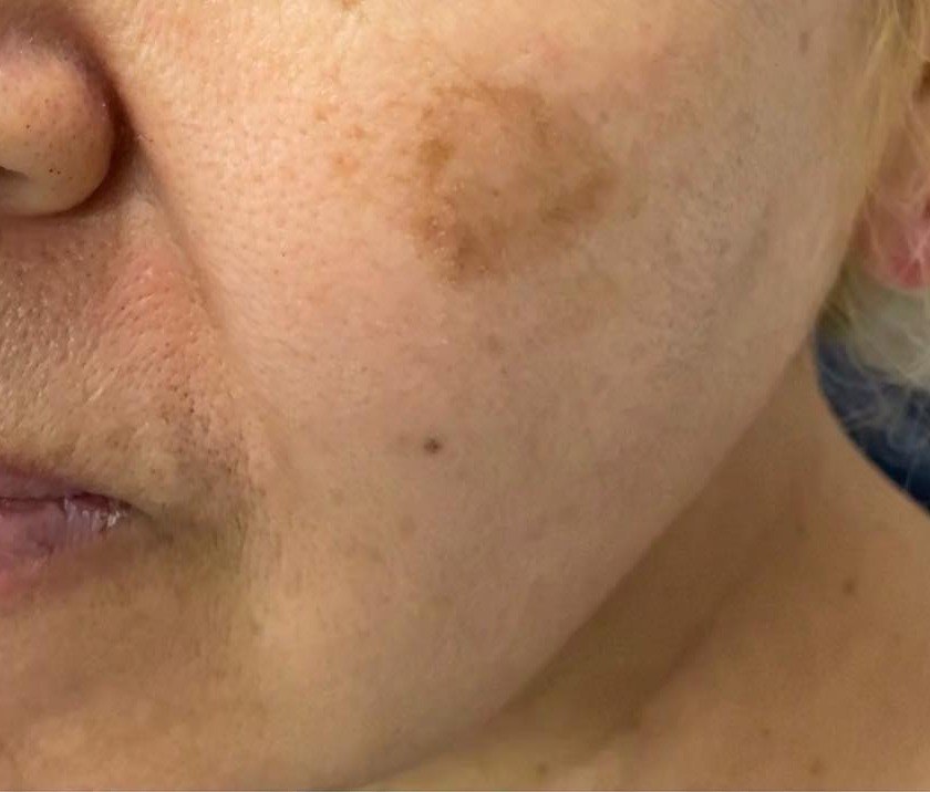 Before VI Peel, hyperpigmentation at Nurse Colette in Phoenix